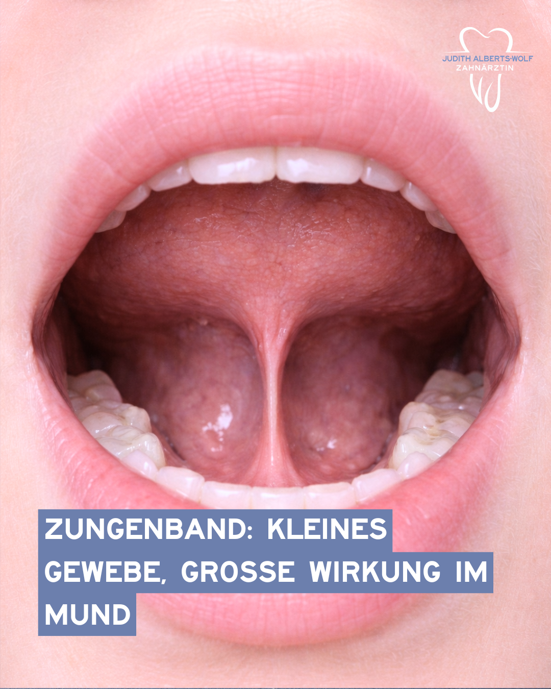 Das Bild zeigt einen geöffneten Mund, mit Fokus auf die erhöhte Zunge. Symbolisch für: Zungenband Kleines Gewebe, große Wirkung